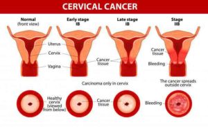 Human Papillomavirus and cancer of the cervix