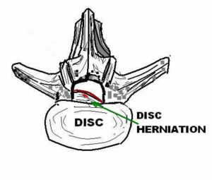 Drawing of a disc herniation in the human lumbar spine