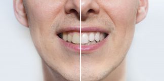 6 Natural Ways to Make Your Teeth Sparkle