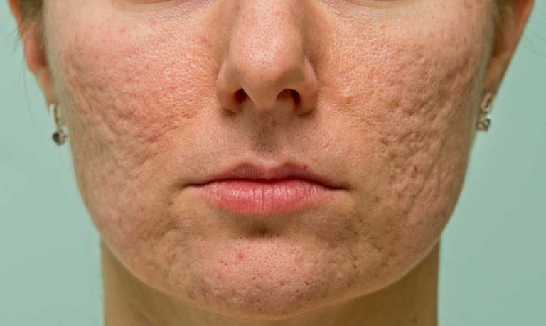 Acne Scars: Facts, Causes, Prevention, and Treatments