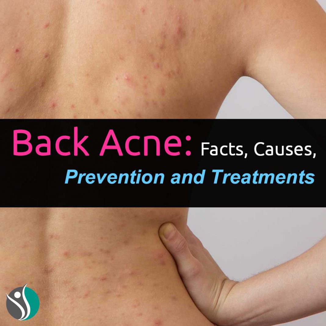 Back Acne Facts, Causes, Prevention, and Treatments Consumer Health