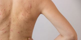 Back Acne Facts, Causes,Prevention and Treatments