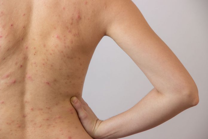 Back Acne Facts, Causes,Prevention and Treatments