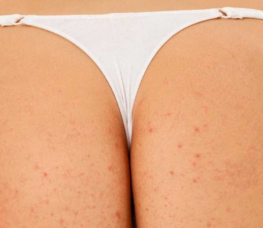 Butt Acne: Facts, Causes, Prevention, and Treatments