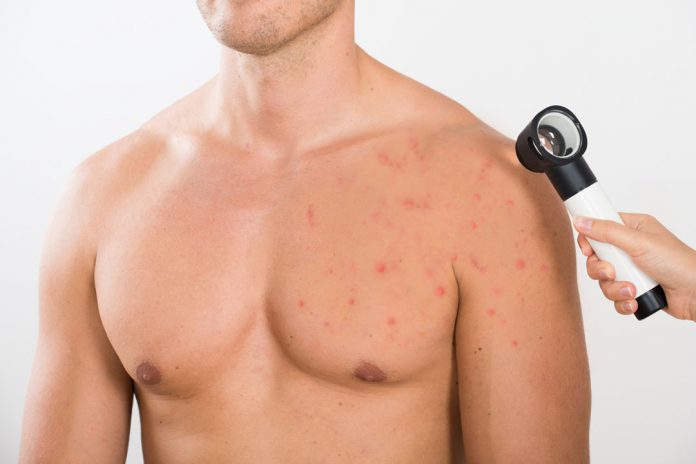 Chest Acne: Facts, Causes, Prevention, and Treatments