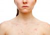 Cystic Acne: Facts, Causes, Prevention, and Treatments