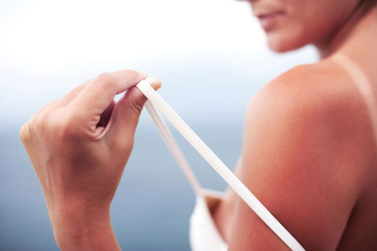 The Best Natural Cure For Sunburn