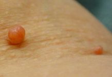The Most Popular Natural Skin Tag Removal Treatments