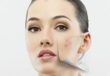 Acne Treatment: 7 Beneficial Teas
