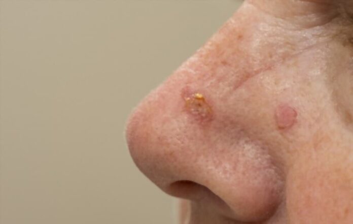 Natural Remedies for Actinic Keratosis