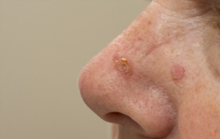 Natural Remedies for Actinic Keratosis