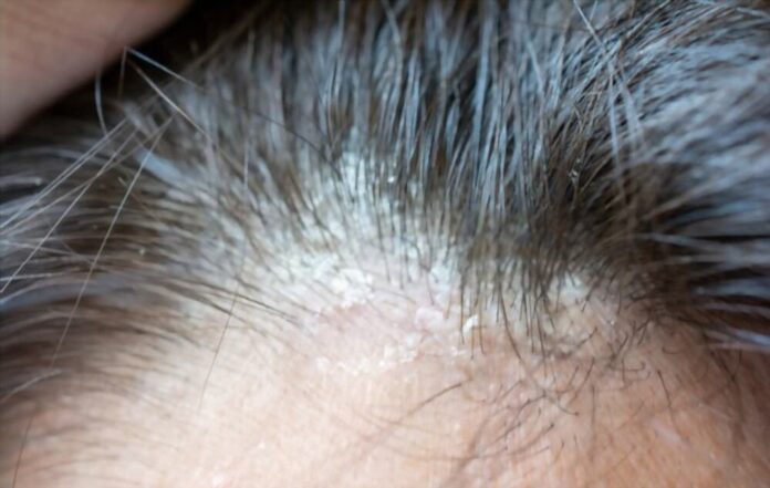 Natural Remedies For Seborrhea