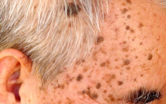 natural-remedies-for-seborrheic-keratosis Natural Remedies for Seborrheic Keratosis