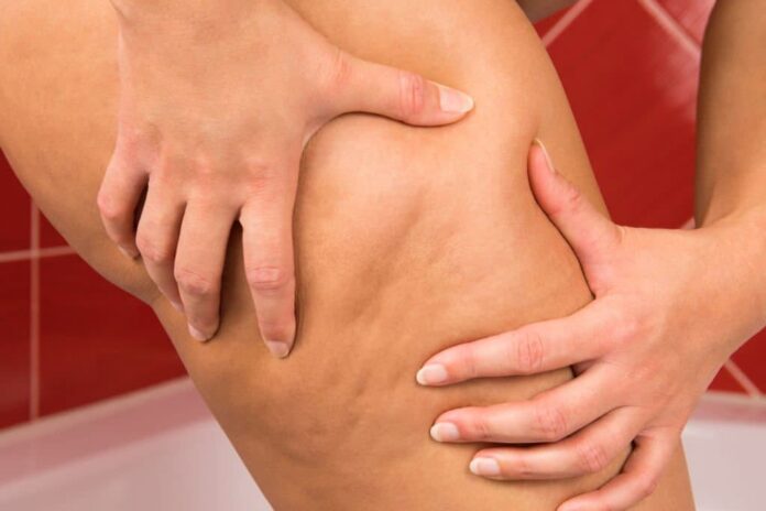 natural-remedy-for-cellulite Natural Remedy For Cellulite
