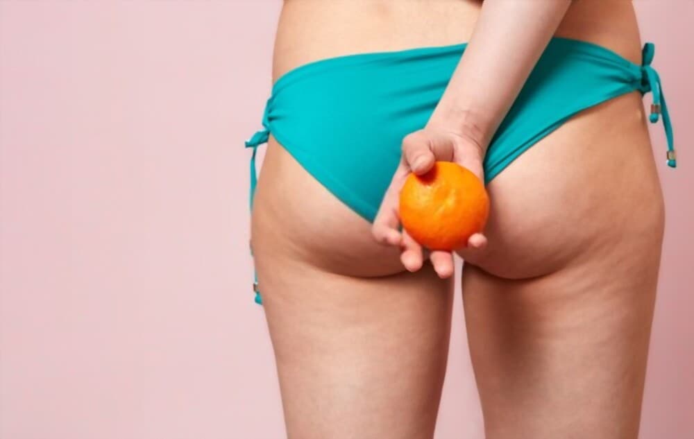 Remedies For Cellulite: Top 4 Allies