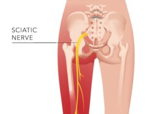 8 Remedies to Relieve Sciatica Pain