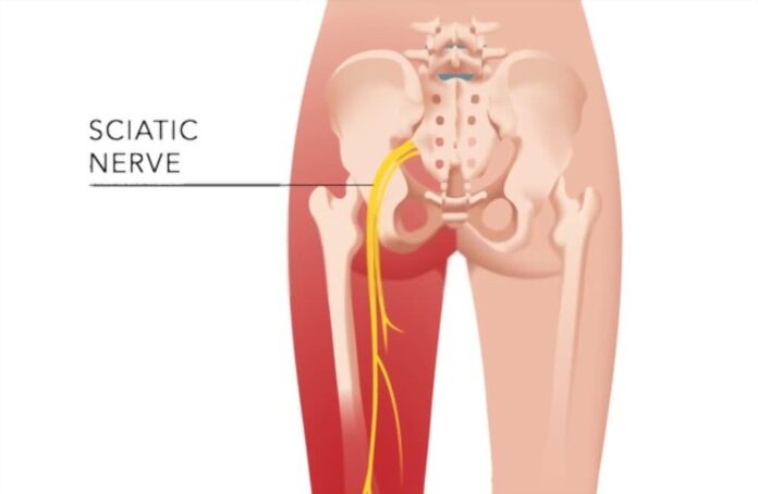 8 Remedies to Relieve Sciatica Pain